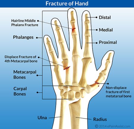 fracture-of-hand-and-finger
